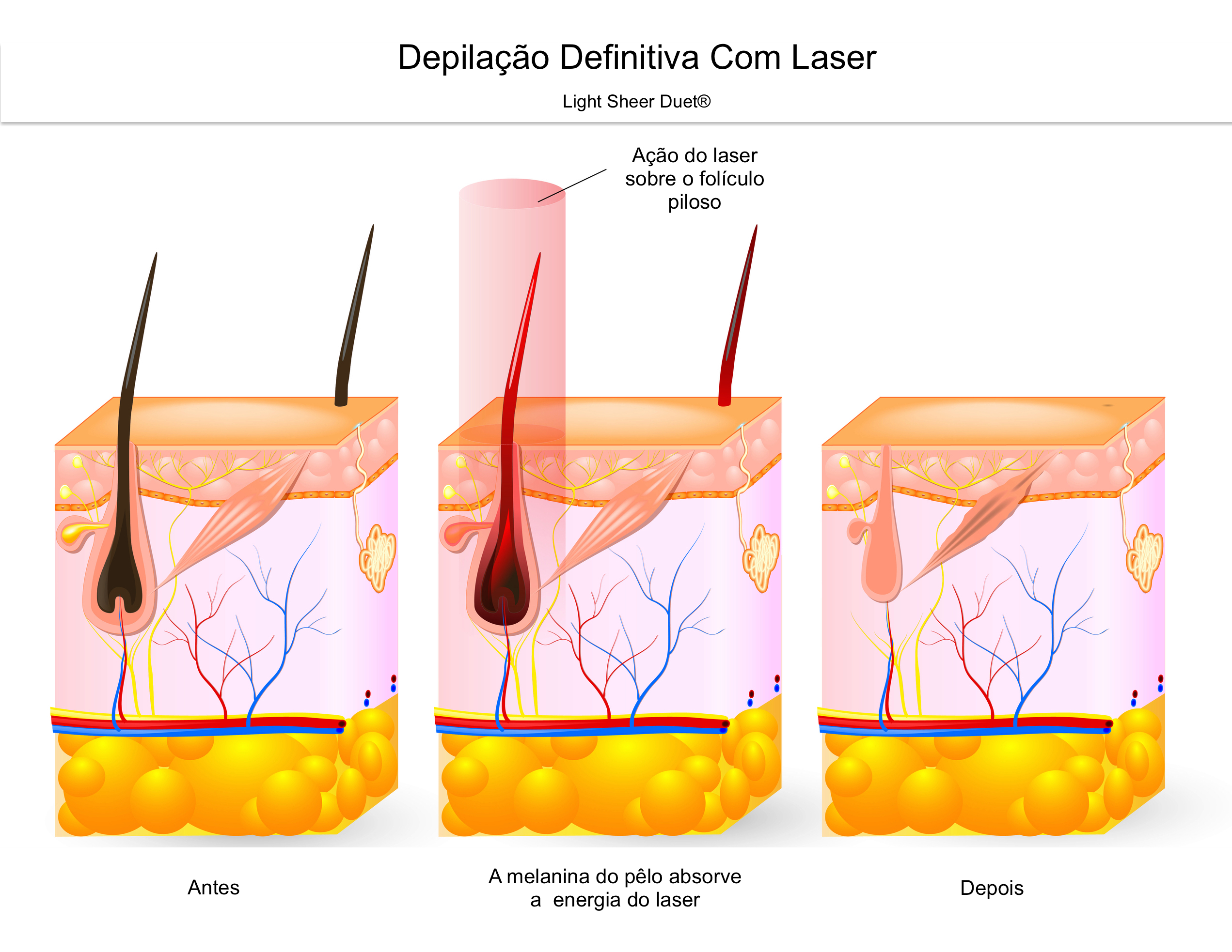 Mistura Apelo Para Ser Atraente Momento Laser Diodo Antes E Depois 